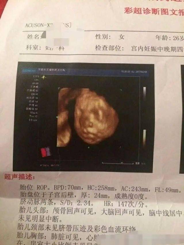 肚脐妊娠线很黑很明显,果真顺产了一个七斤男宝宝_肚子