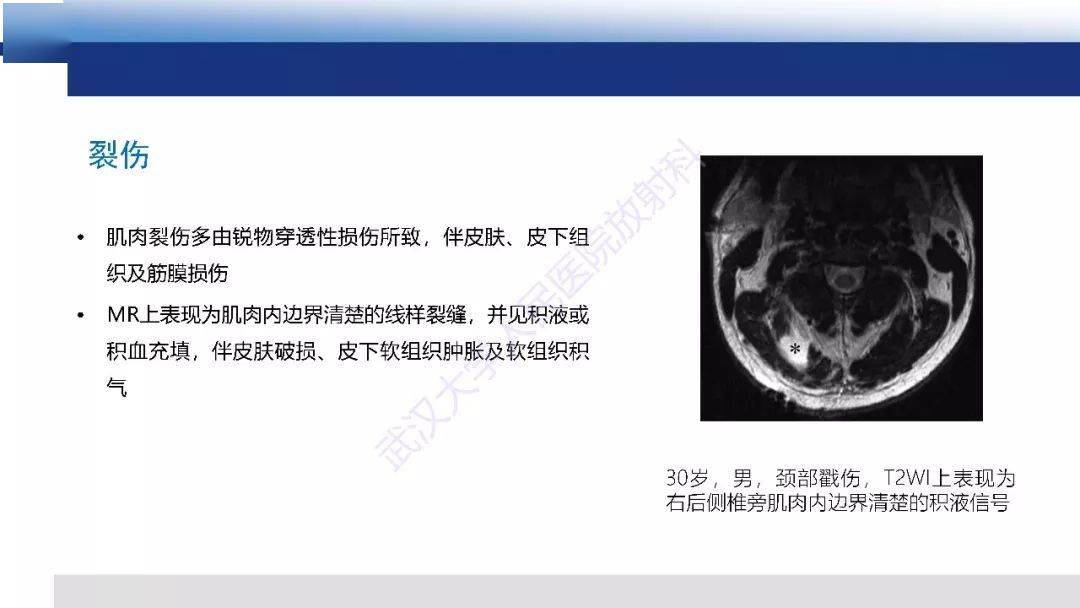 肌肉创伤mr诊断:解剖,生物力学,病理生理学及影像学表现