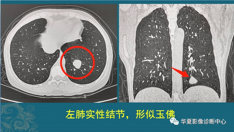肺上有结节5个细节揭示有没有癌细胞医生教你看ct片