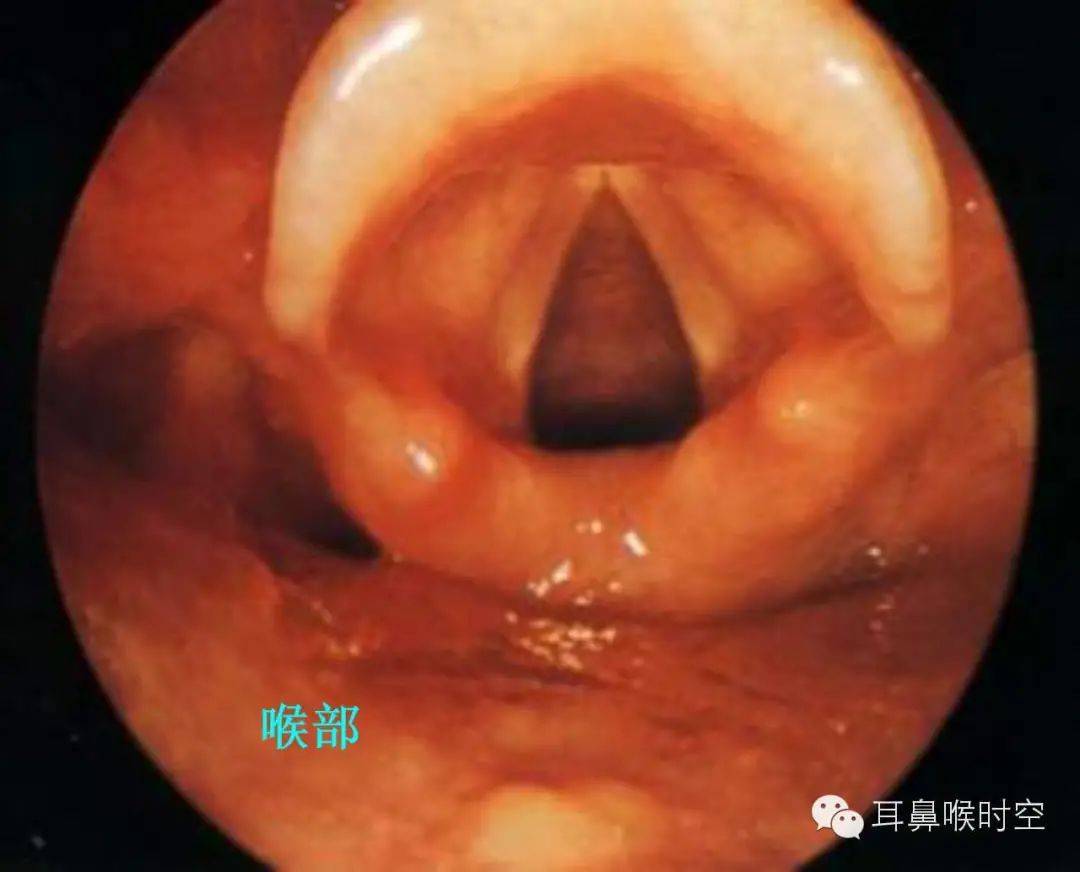 耳鼻咽喉,食道及气管异物的处理方法