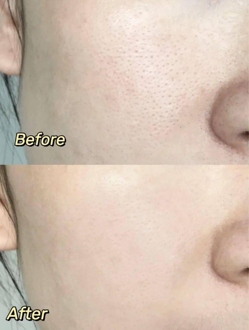 黑头|只要39元，轻松“磨皮”，让你的皮肤好到爆！