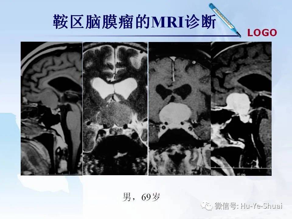 影像鞍区肿瘤的mri鉴别诊断