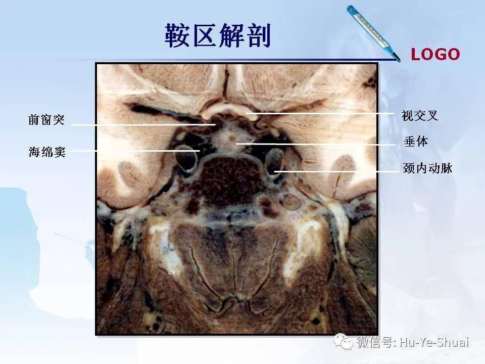 影像鞍区肿瘤的mri鉴别诊断