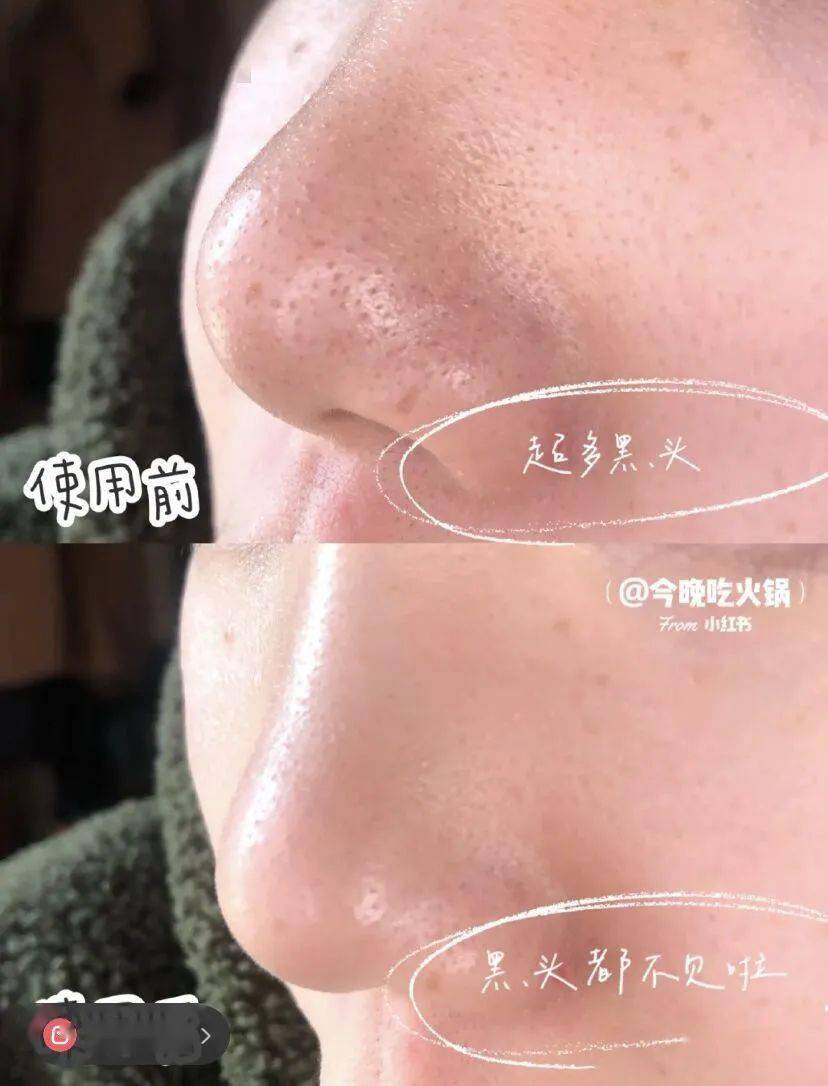 黑头|只要39元，轻松“磨皮”，让你的皮肤好到爆！