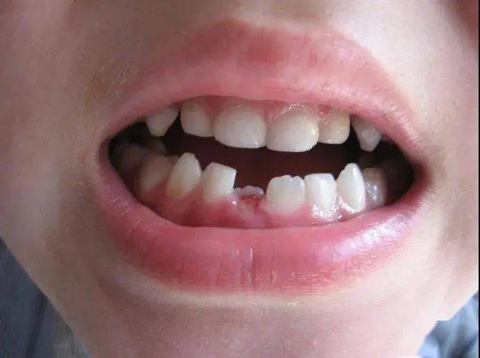 【儿童替牙期的烦恼】门牙变成大板牙是怎么回事?