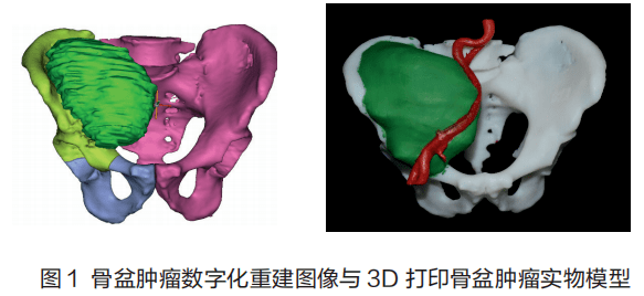 3d打印翻开骨盆肿瘤治疗快准好的新篇章