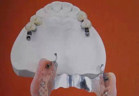 最全的活动假牙的介绍及材料_义齿