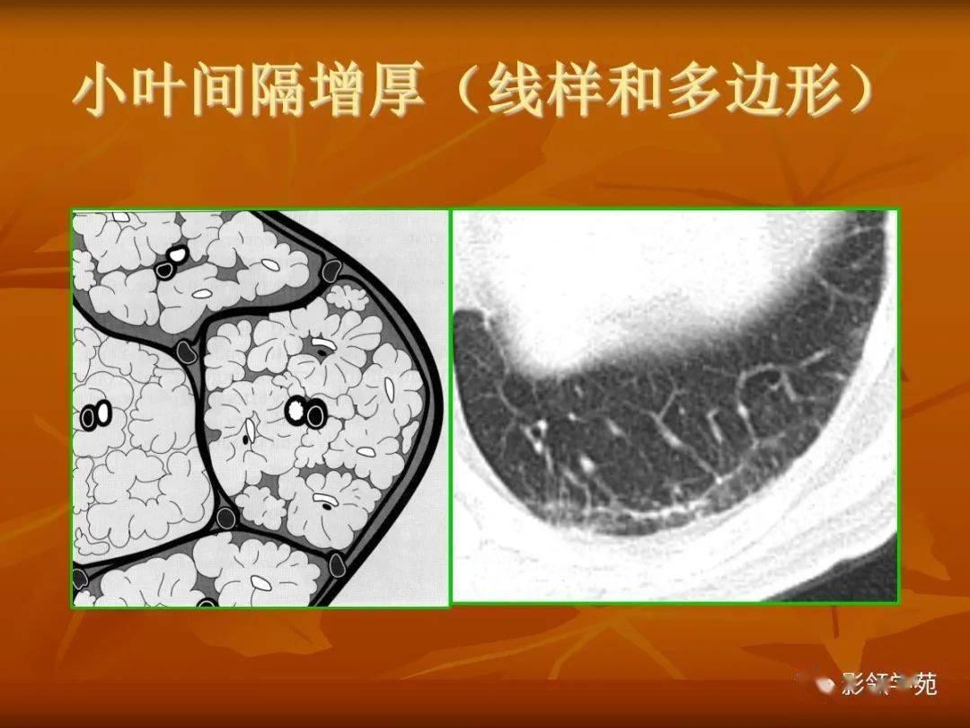 7种肺部基本病变影像表现