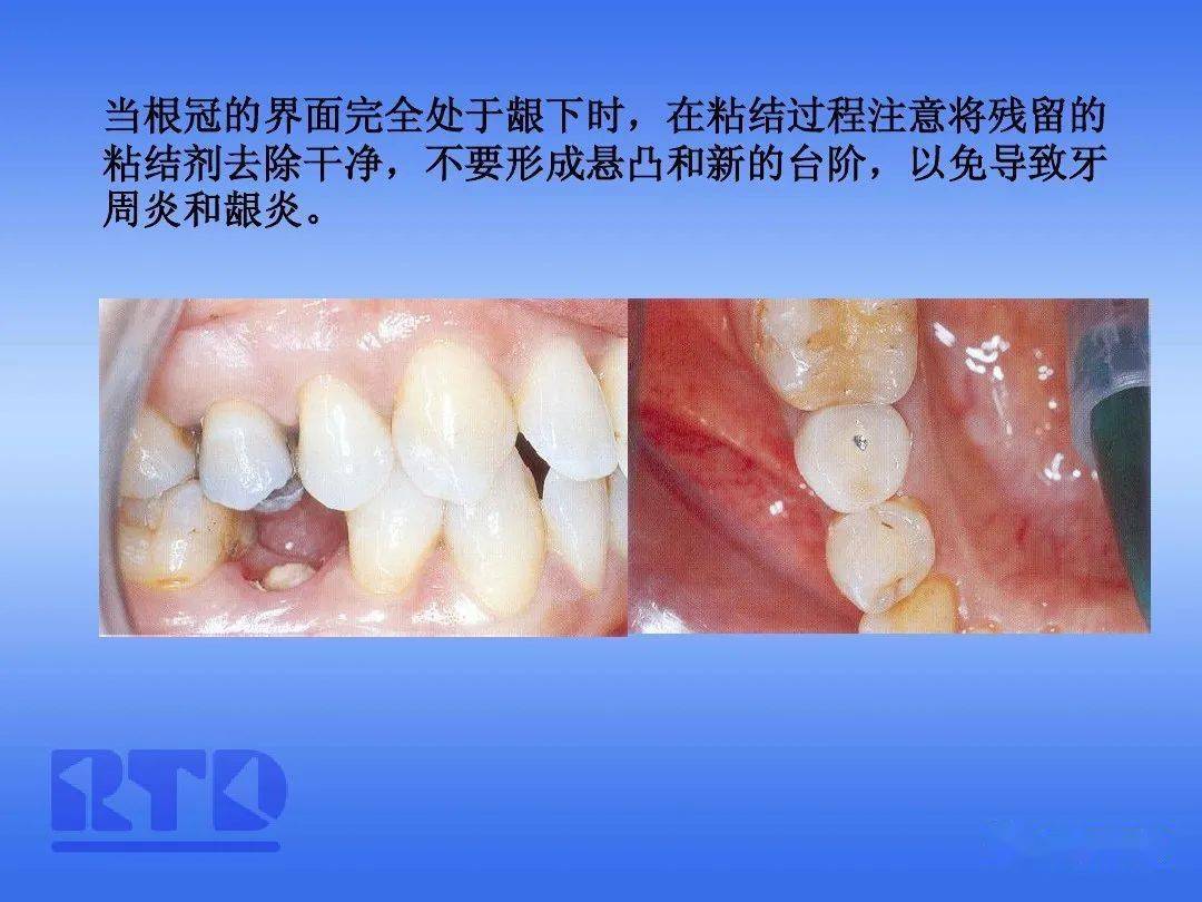 纤维桩技术及其在临床的应用