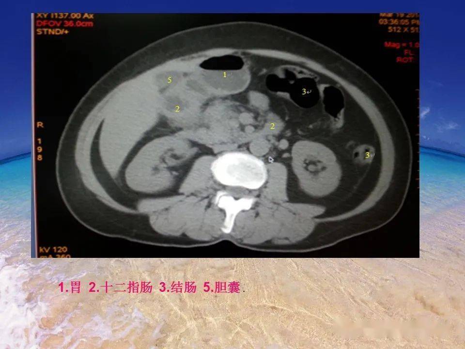 消化道穿孔的ct诊断