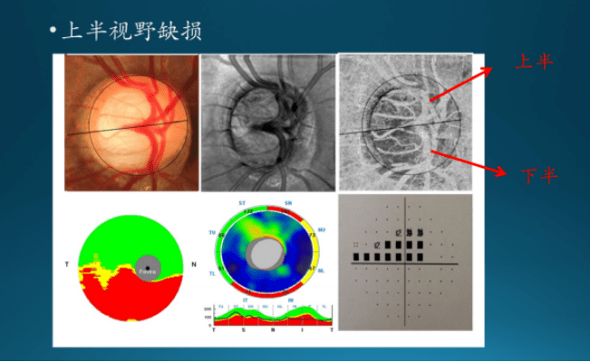 ccos青光眼丨陈君毅教授:原发性房角关闭性疾病的视网膜微循环改变