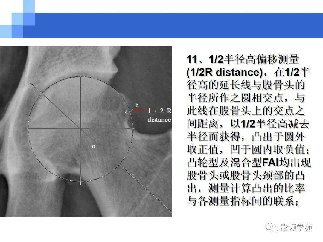 股髋撞击综合征(fai)影像学诊断_髋关节