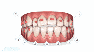 口呼吸不仅影响颜值还影响牙齿，记录牙齿变歪的过程！