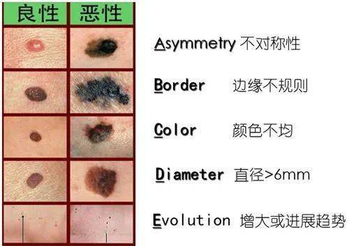 双生痣是好痣还是坏痣 59b04bb3bb9c4318af569999150382ad.jpeg