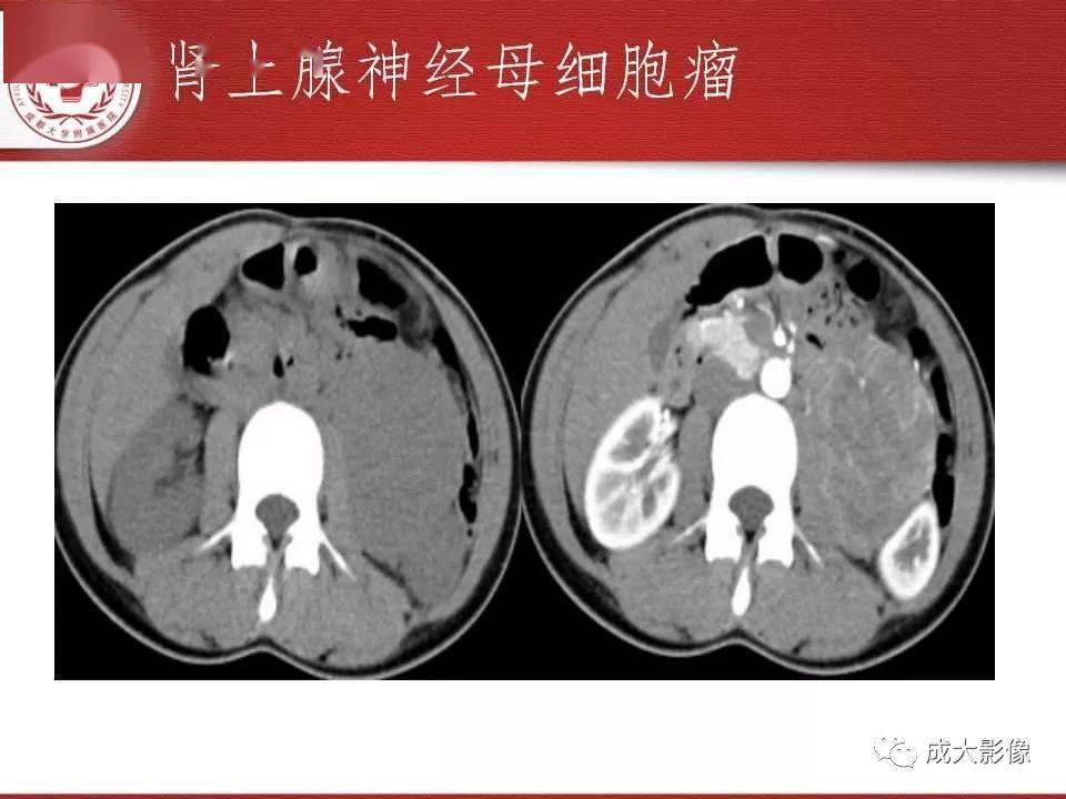 观察·双肾上极肾周间隙·周围脂肪包裹·左肾上腺位于左肾上极前内侧