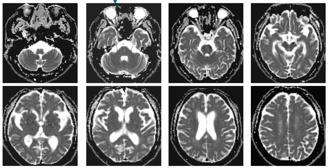 头颅mri