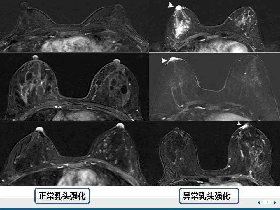 【每日一例1205】乳腺paget病(病例精读分析)