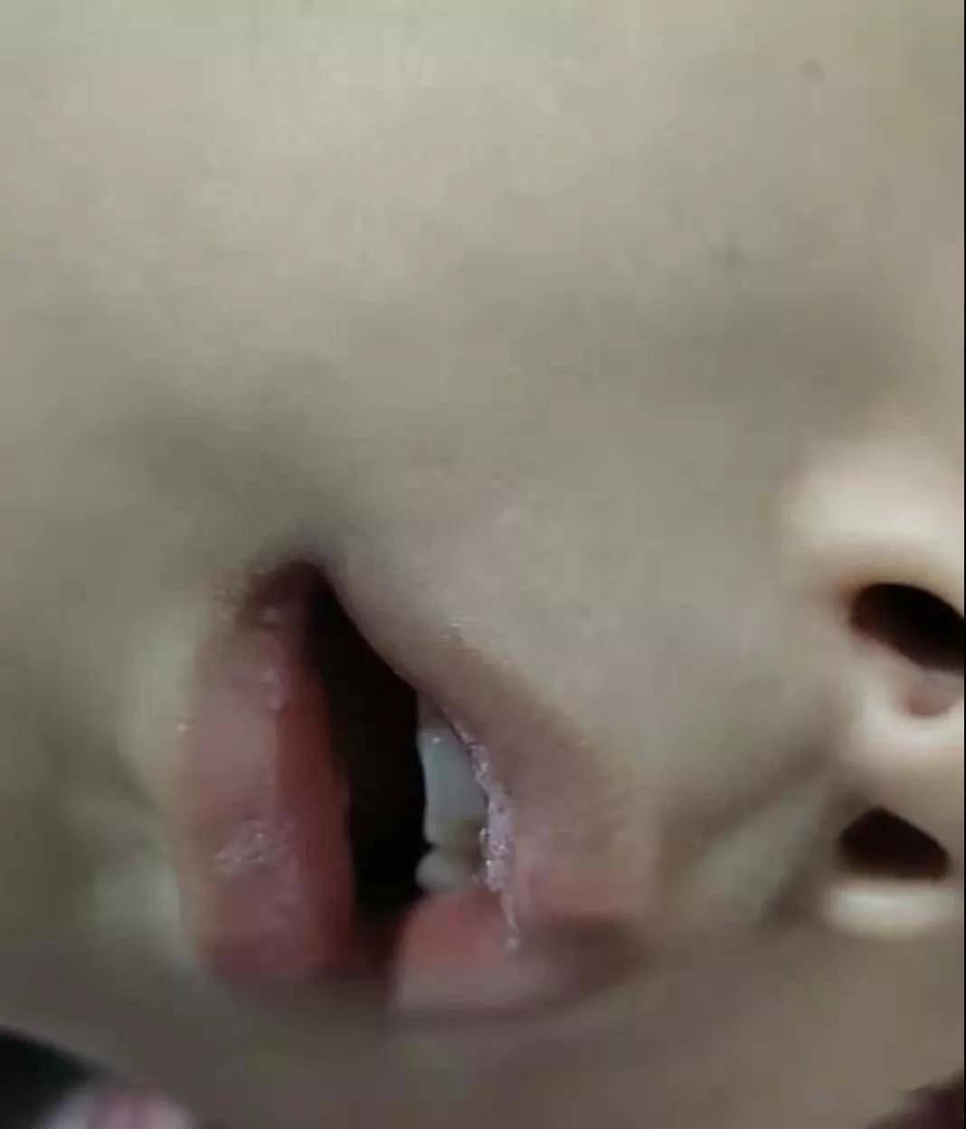 儿童口呼吸,2种情况,3种危害,医生:需要治疗和养护