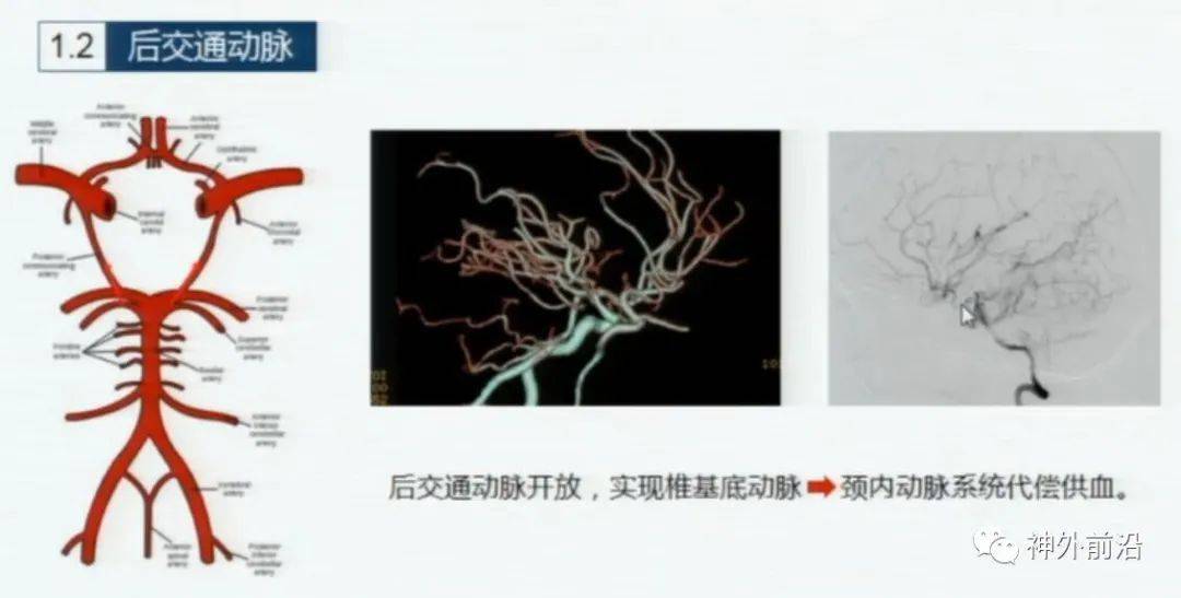 前交通动脉开放沟通左右颈内动脉系统的血流.