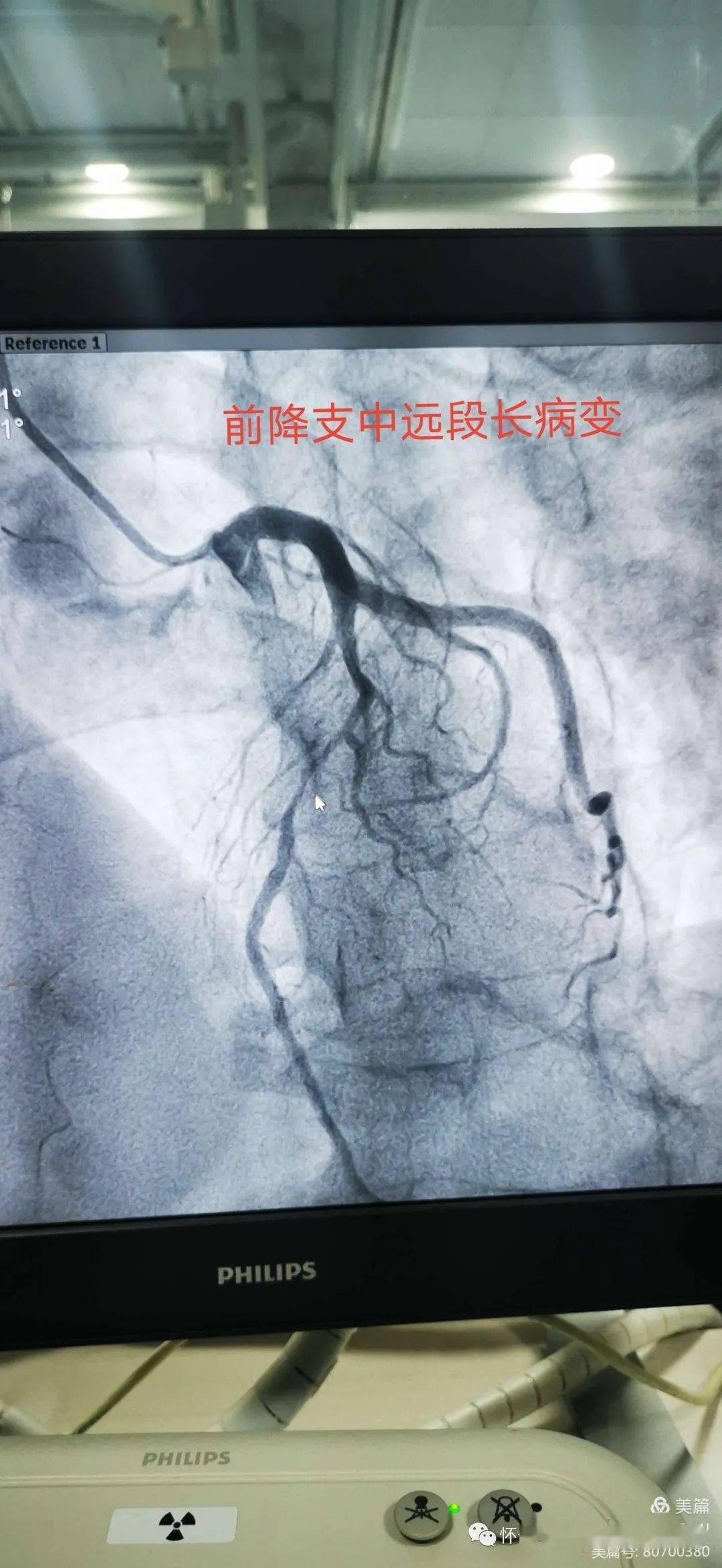 【特别关注】怀仁市人民医院介入导管室完成冠脉造影11例,支架植入2例
