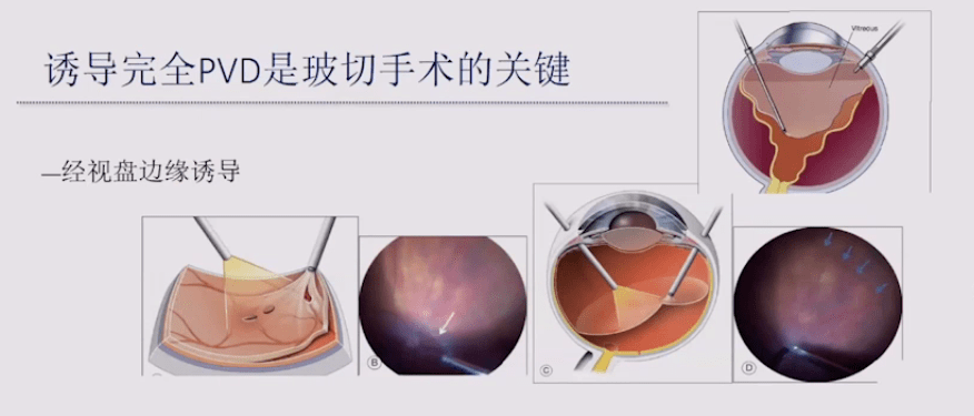 玻璃体手术的关键在于制作人工玻璃体后脱离并彻底清除玻璃体后皮质.