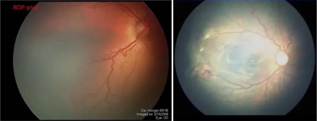 的病变与rop的plus病变十分相似(图3,但该患儿是足月,正常体重新生儿