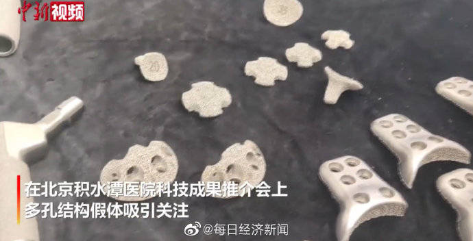 钛合金|北京一医院推出3D打印关节翻修假体 已造福两百余患者