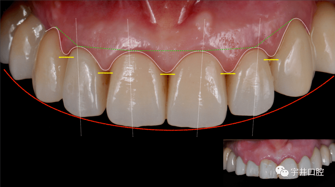 病例分享前牙区美学种植