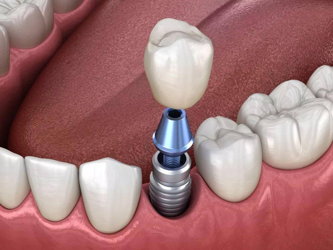 国际种植牙先进技术落户延边种牙不疼不肿避免手术风险探秘无痛微创