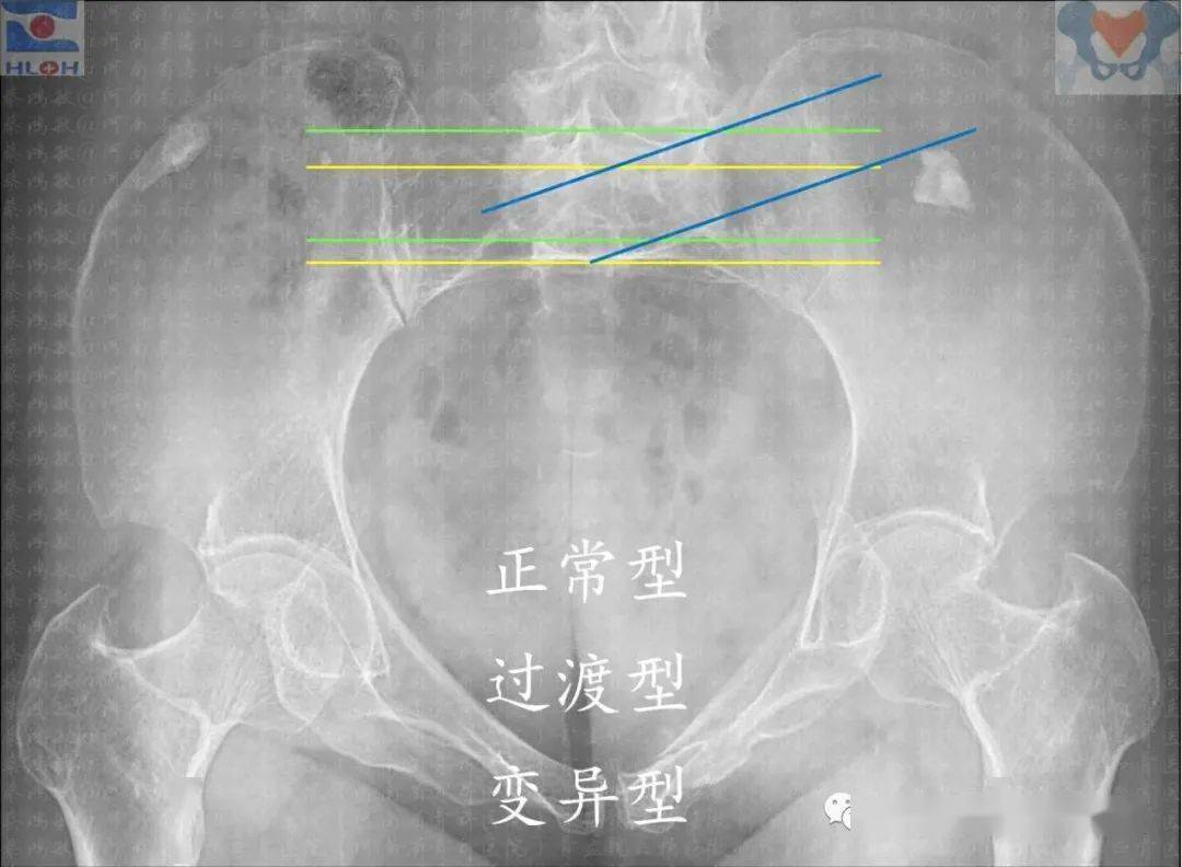 骶髂螺钉正确指向图解:通晓规律,免除错误,远离危险