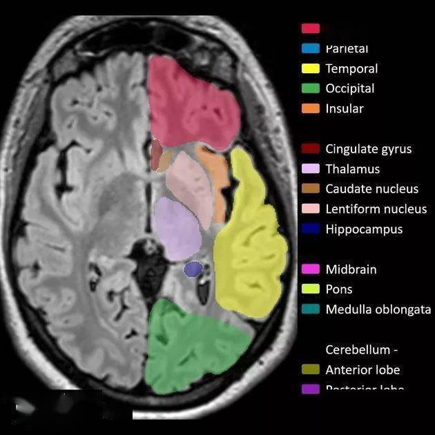 mr入门丨脑叶解剖分布mri图像彩色标注