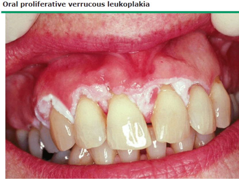 口腔增生性疣状白斑患者牙龈边缘广泛的白色疣状斑块3红斑红斑是一种