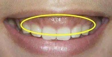 临床药师提醒硝苯地平与药物性牙龈增生