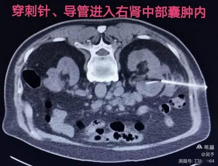肾囊肿穿刺硬化治疗_右肾
