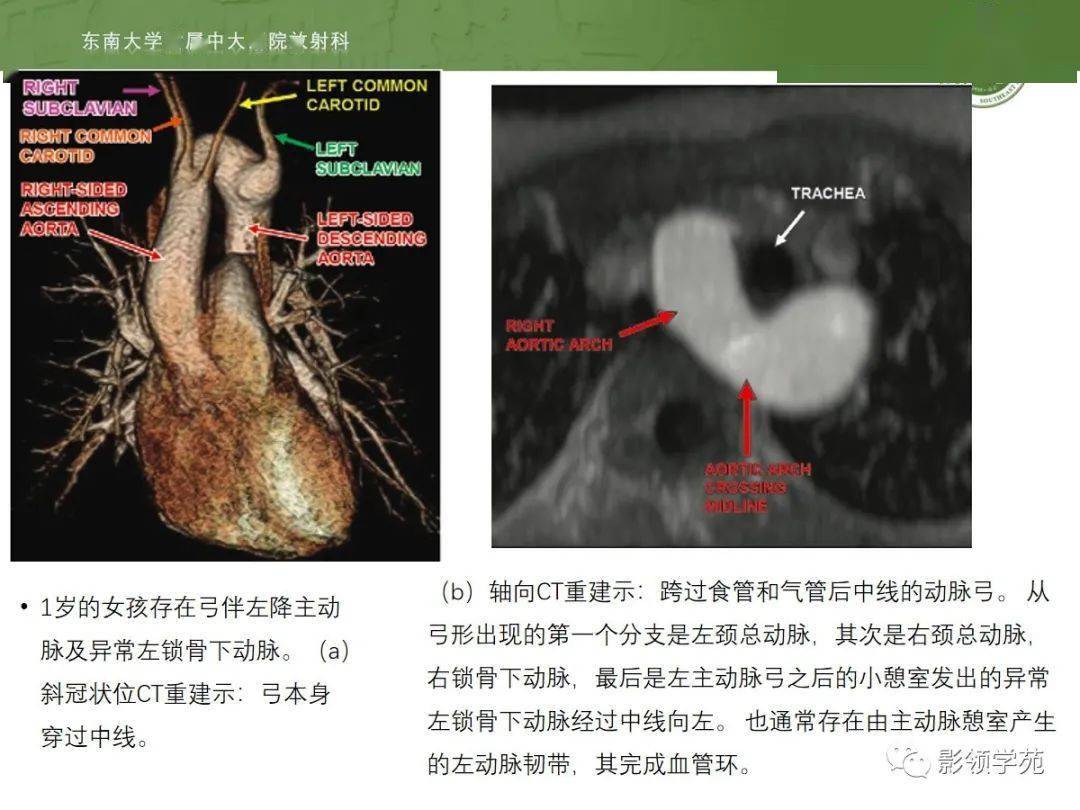 主动脉弓先天变异和异常影像表现