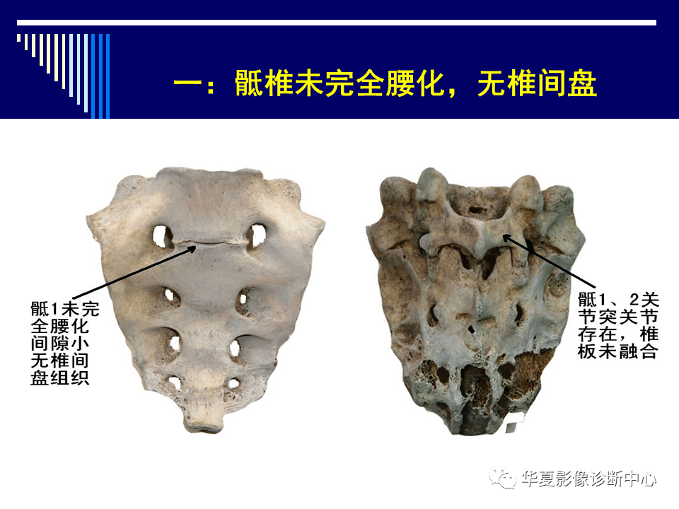 经典课件影像那些需要知道系列骶骨的解剖学变异