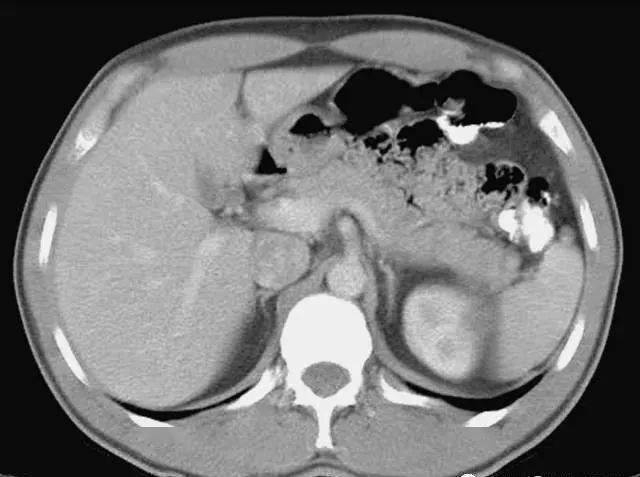 每位影像科医生都应该掌握的腹部ct基础读片36张,看完