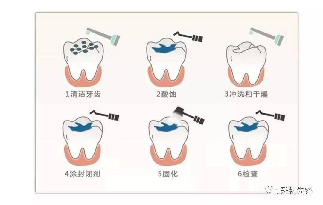 为什么提倡孩子做窝沟封闭,最佳年龄是什么时候?