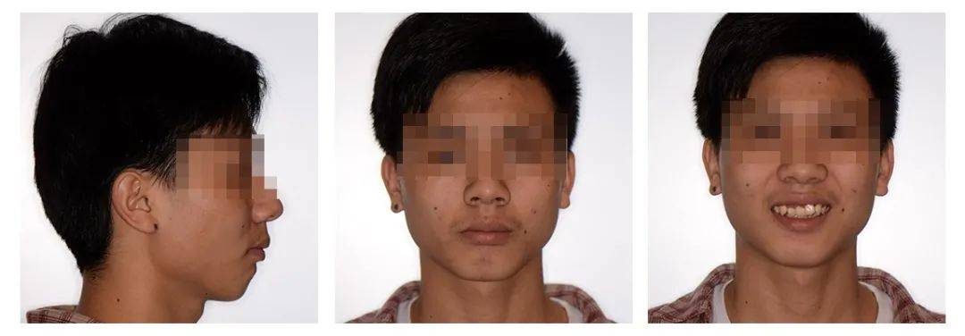 tmj:双侧髁突不对称,未见明显异常.