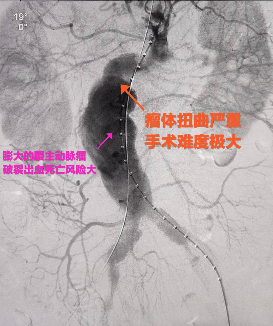 保护生命安全——天津医科大学第二医院血管外科团队成功实施腹主动脉