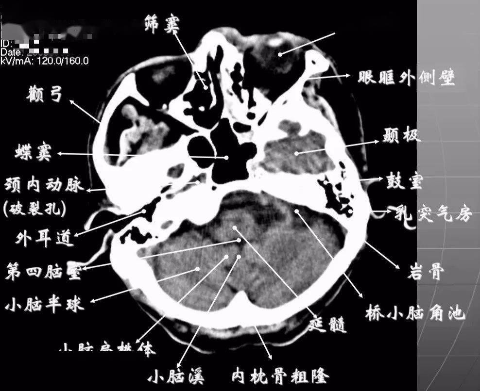 简明又详细的头部ct读片详解收藏