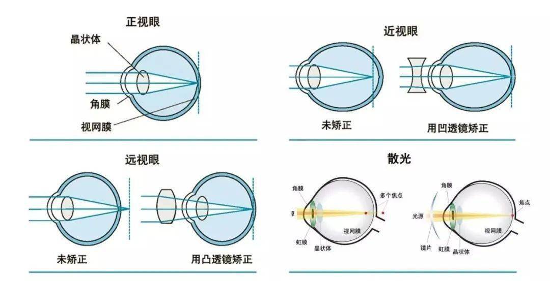 什么是屈光不正?