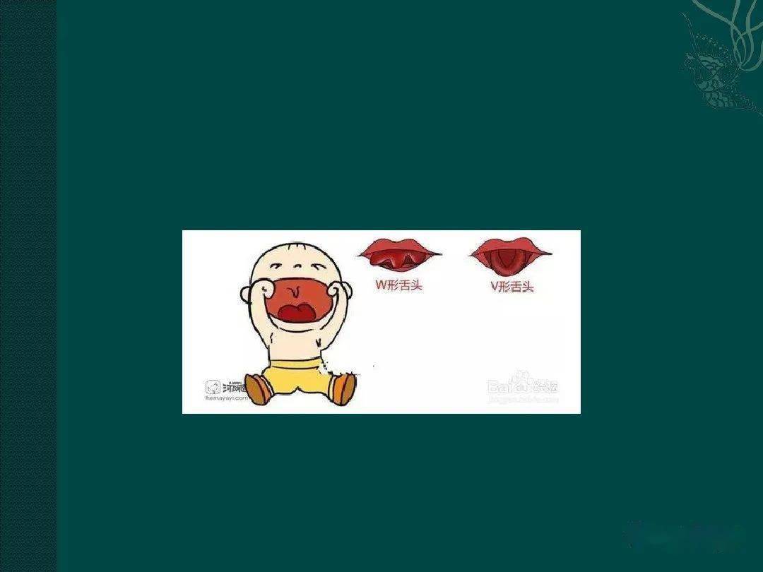 舌系带过短的诊断与治疗
