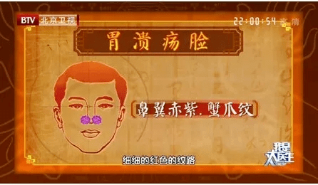 据临床研究,出现蟹爪纹的人,大部分幽门螺旋杆菌检测结果均为阳性.