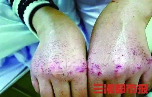 梦境解析，梦见与他人争斗，胳膊上布满血痕的深层含义