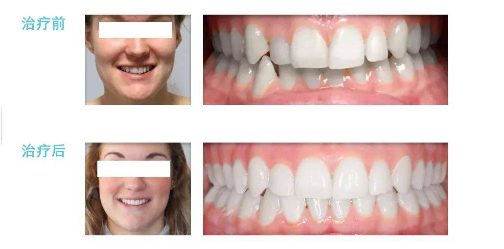 女人梦见满口牙全掉了，梦境背后的深层含义与心理解析