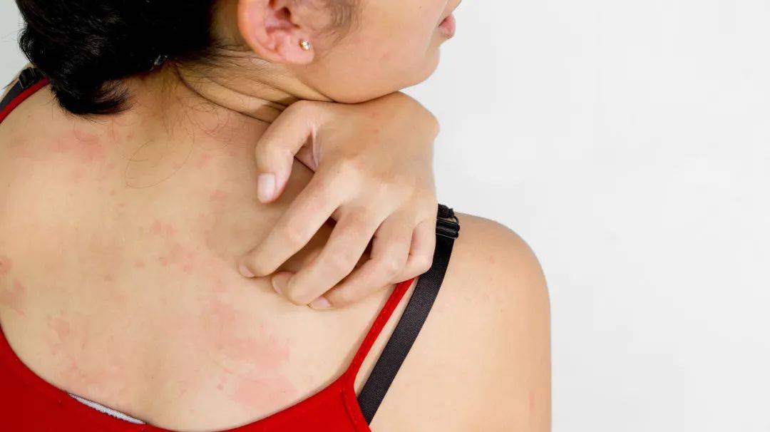 皮肤瘙痒是许多皮肤病共有的一种自觉症状,如仅有皮肤瘙痒而无原沸栽