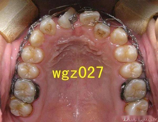 一例上颌中切牙严重扭转矫治经典过程组图