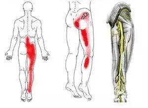 臀部大腿又疼又麻有时串到小腿坐骨神经痛该怎么破