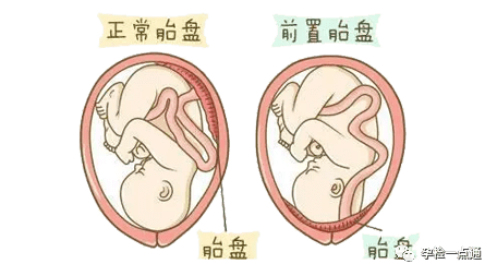 位置低于胎儿的先露部,称为前置胎盘